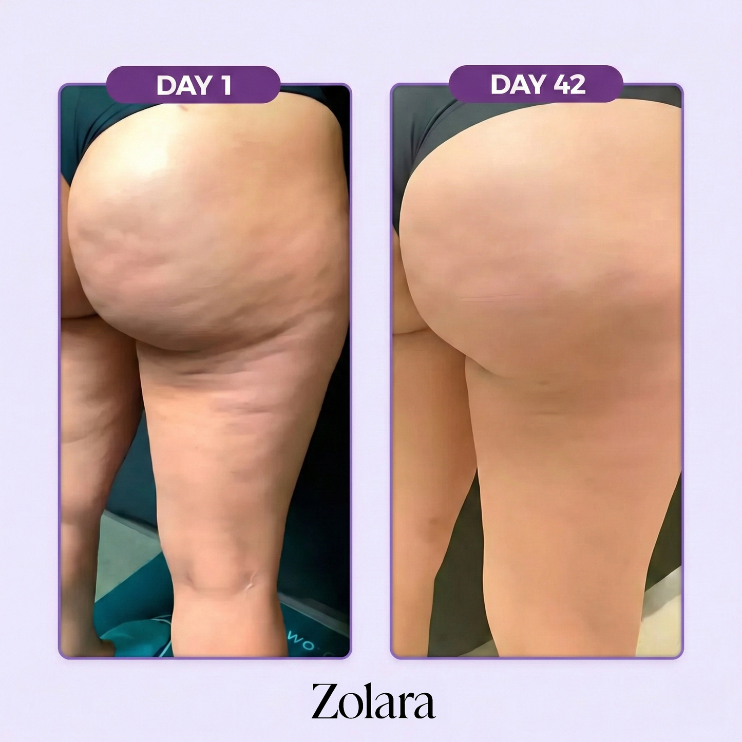 4-in-1 Cellulite Device
